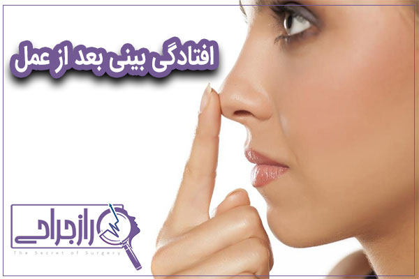 افتادگی بینی بعد از عمل - راز جراحی