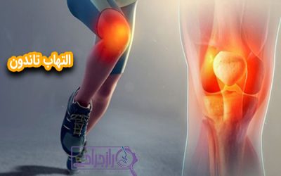 التهاب تاندون