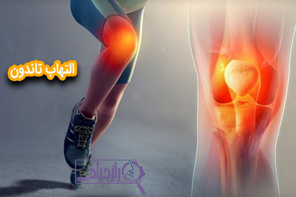 التهاب تاندون - راز جراحی