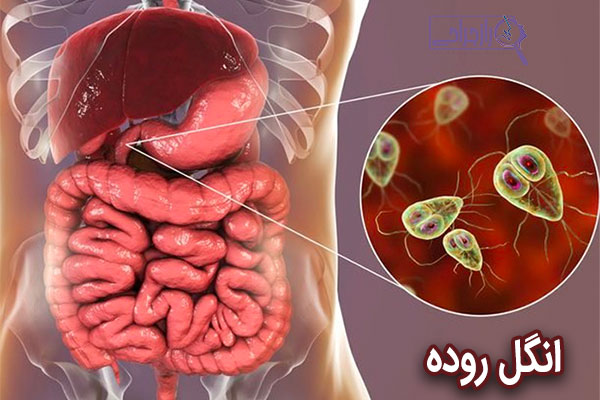 انگل روده - راز جراحی