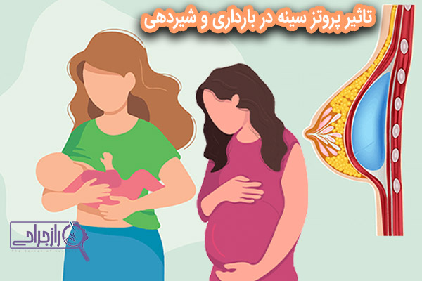 تاثیر پروتز سینه در بارداری و شیردهی - راز جراحی