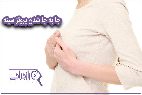 جا به جا شدن پروتز سینه - راز جراحی