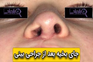 جای بخیه بعد از جراحی بینی - راز جراحی