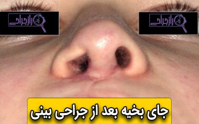 جای بخیه بعد از جراحی بینی
