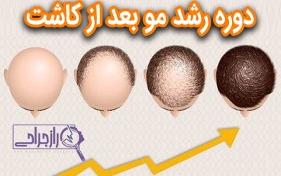 دوره رشد مو بعد از کاشت