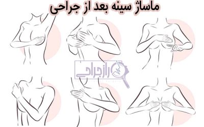 ماساژ سینه بعد از جراحی ۰ تا ۱۰۰ + راز جراحی