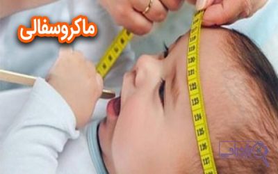 ماکروسفالی