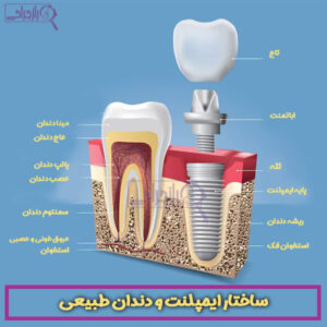 ایمپلنت دندان - راز جراحی 