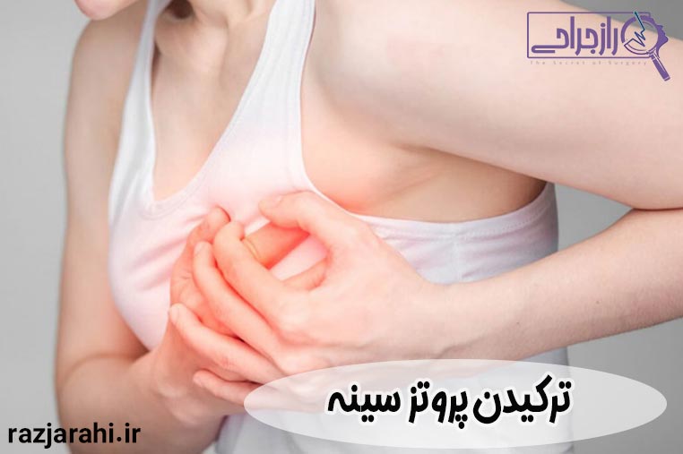 ترکیدن پروتز سینه