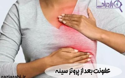عفونت بعد از پروتز سینه