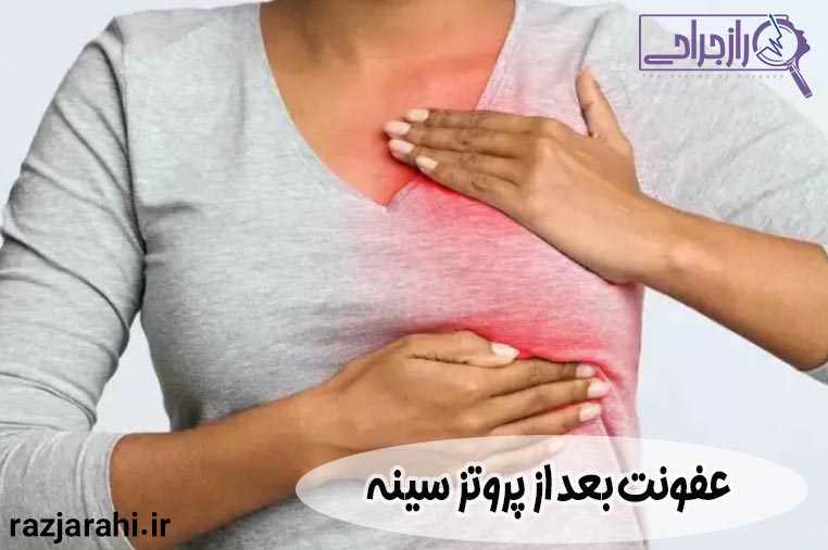 عفونت بعد از پروتز سینه