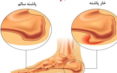 خار پاشنه + راههای خلاص شدن از آن