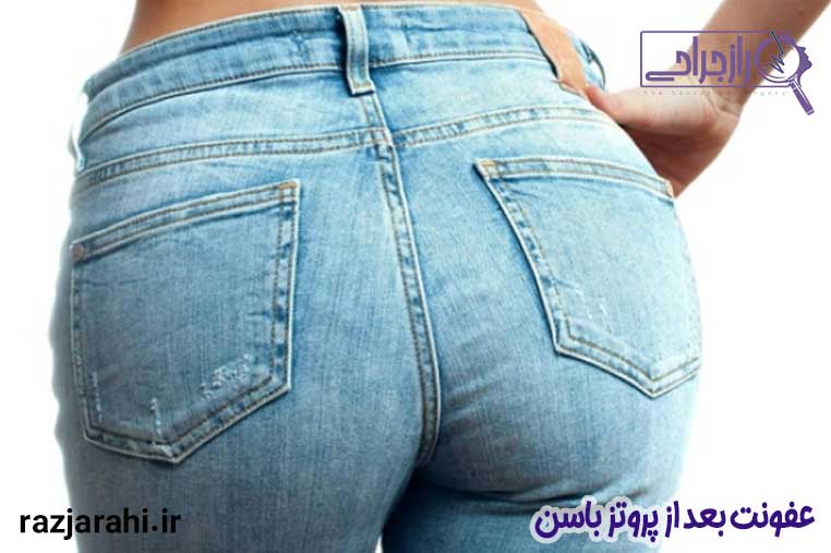 عفونت بعد از پروتز باسن