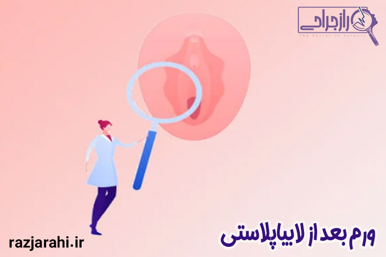 ورم بعد از لابیاپلاستی