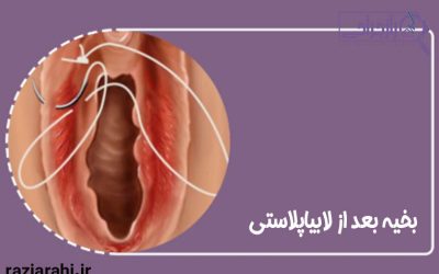 بخیه بعد از لابیاپلاستی