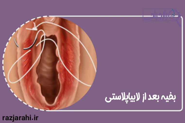 بخیه بعد از لابیاپلاستی