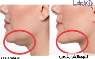 لیپوساکشن غبغب
