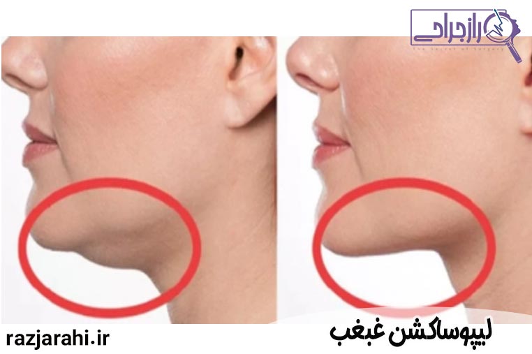 لیپوساکشن غبغب