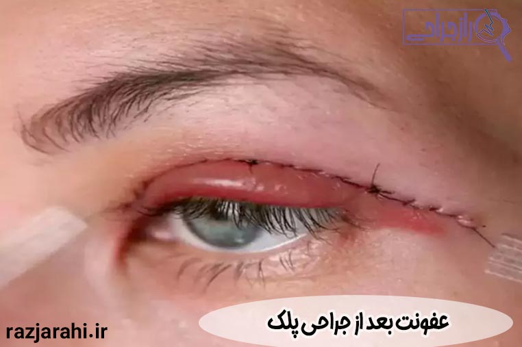 عفونت بعد از جراحی پلک