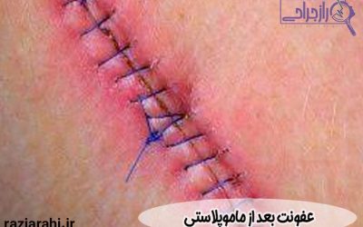 عفونت بعد از ماموپلاستی | علائم + راههای درمان
