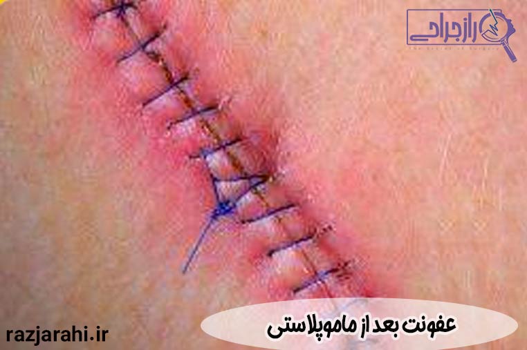 عفونت بعد از ماموپلاستی