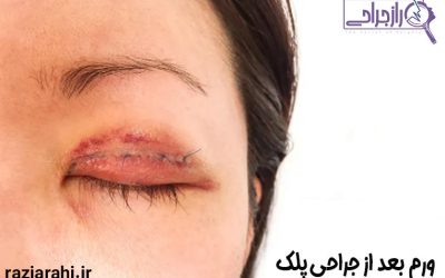 ورم بعد از جراحی پلک | از علل تا راه های درمان آن