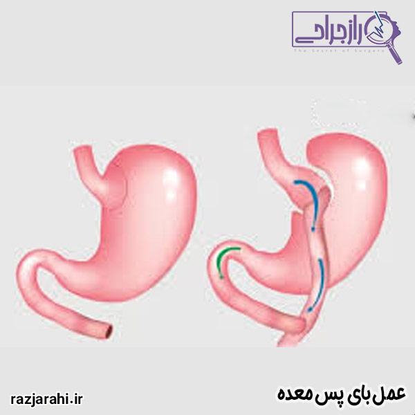 عمل بای پس معده