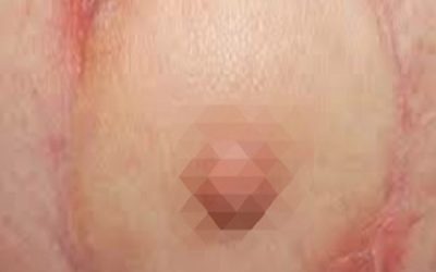 نکروز بعد از ماموپلاستی چیست و آیا قابل پیشگیری است؟