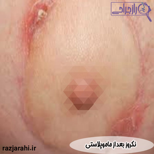نکروز بعد از ماموپلاستی