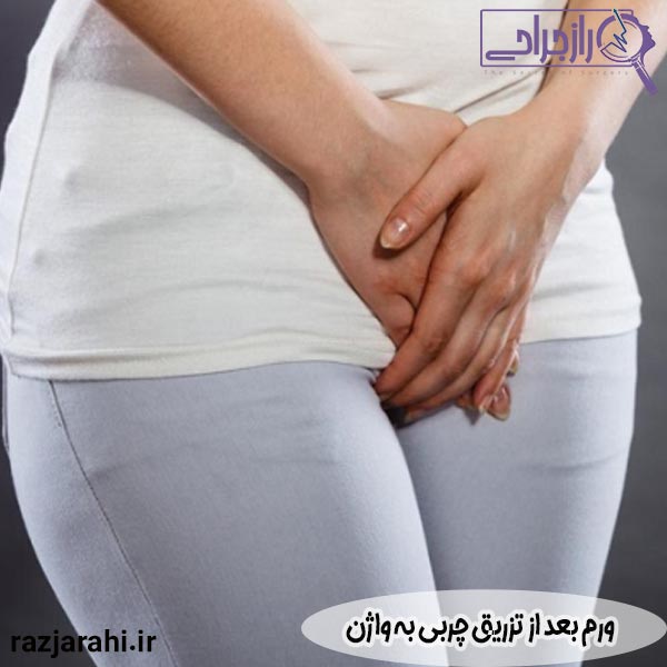 ورم بعد از تزریق چربی به واژن